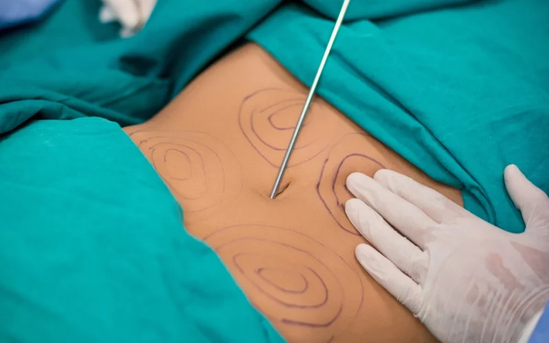 Liposuction