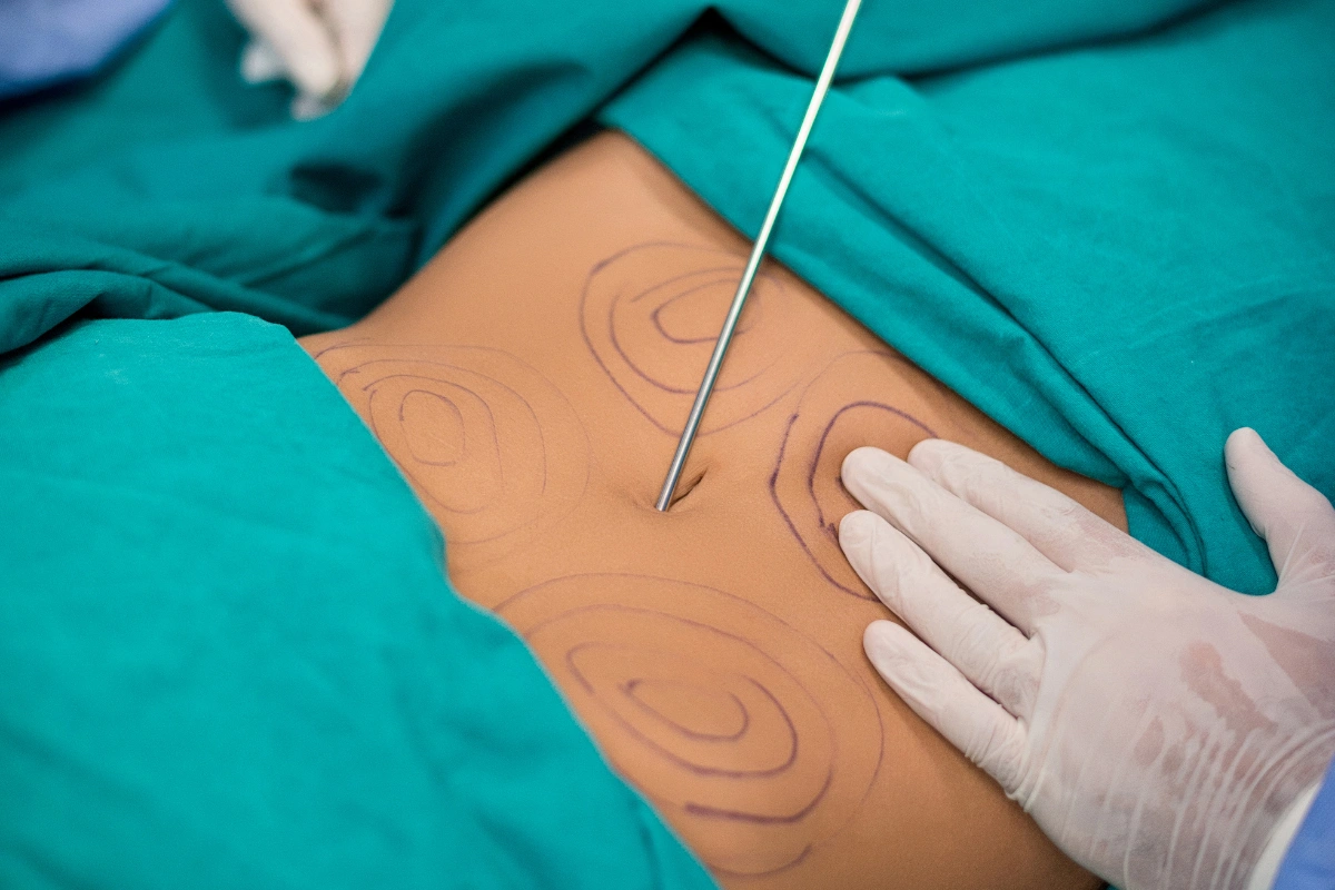 Liposuction (Yağ Aldırma)